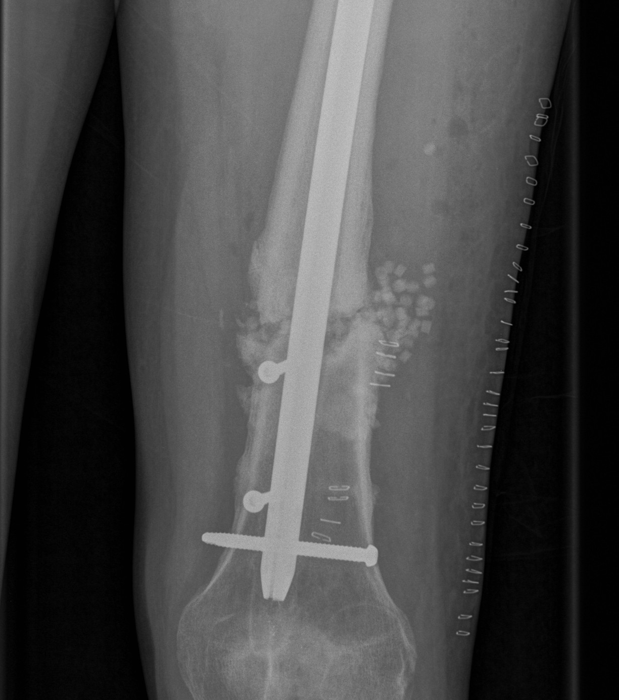 Exchange Nail Bone Graft